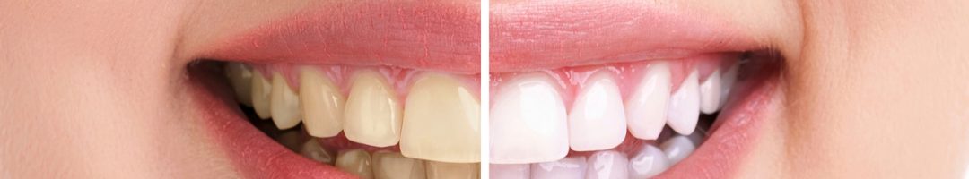 4 aliments qui blanchissent naturellement les dents